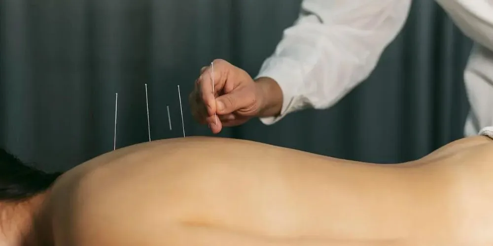Significance of Acupuncture in Modern world 