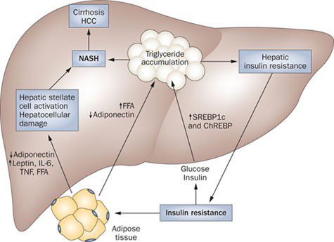 Type 2 Diabetes and Fatty Liver Disease