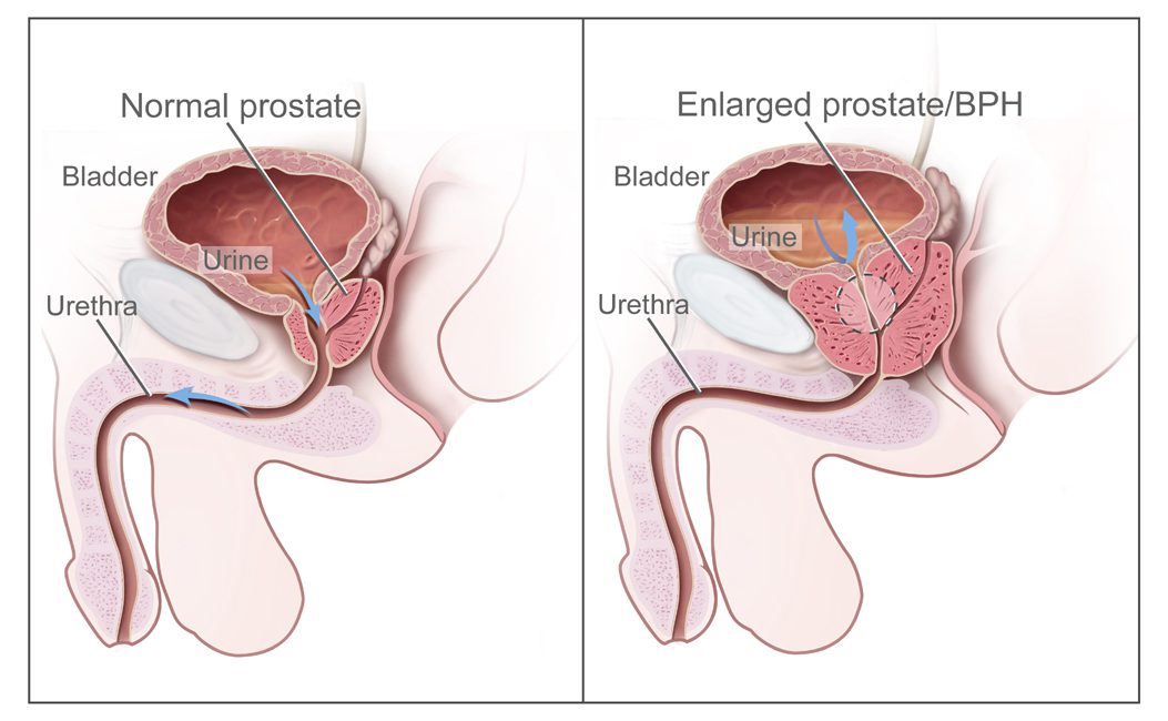 Benign prostatic hyperplasia (BPH)