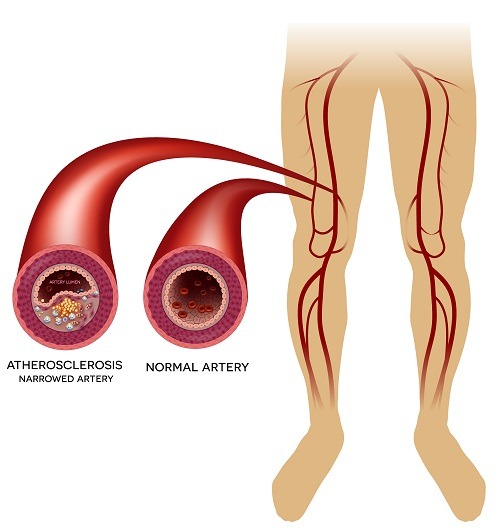 DIABETIC ARTERY DISEASE